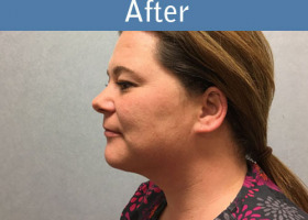 Milwaukee Plastic Surgery - Liposuction - 11-2
