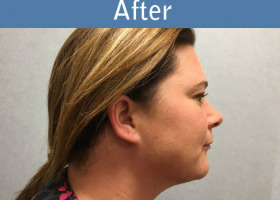 Milwaukee Plastic Surgery - Liposuction - 11-4