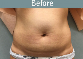 Milwaukee Plastic Surgery - Liposuction - 12-1