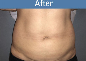 Milwaukee Plastic Surgery - Liposuction - 12-2
