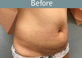 Milwaukee Plastic Surgery - Liposuction - 12-3