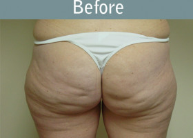 Milwaukee Plastic Surgery - Liposuction - 1-1