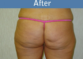 Milwaukee Plastic Surgery - Liposuction - 1-2