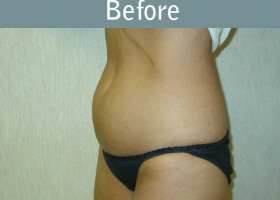 Milwaukee Plastic Surgery - Liposuction - 2-1