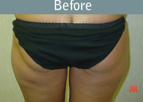 Milwaukee Plastic Surgery - Liposuction - 5-1