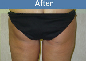 Milwaukee Plastic Surgery - Liposuction - 5-2
