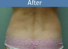Milwaukee Plastic Surgery - Liposuction - 6-2