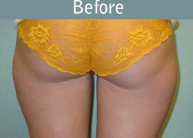Milwaukee Plastic Surgery - Liposuction - 7-1