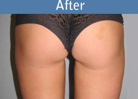 Milwaukee Plastic Surgery - Liposuction - 7-2