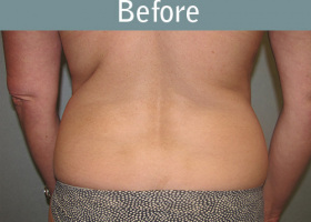 Milwaukee Plastic Surgery - Liposuction - 8-1