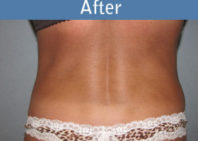 Milwaukee Plastic Surgery - Liposuction - 8-2