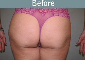 Milwaukee Plastic Surgery - Liposuction - 8-3