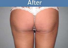 Milwaukee Plastic Surgery - Liposuction - 8-4