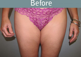 Milwaukee Plastic Surgery - Liposuction - 8-5