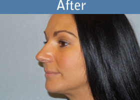 Milwaukee Plastic Surgery - Liposuction - 9-2
