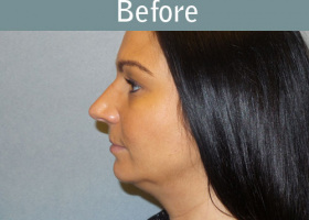 Milwaukee Plastic Surgery - Liposuction - 9-3