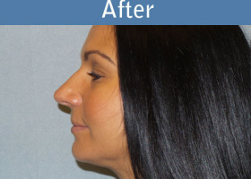 Milwaukee Plastic Surgery - Liposuction - 9-4