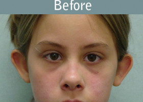 Milwaukee Plastic Surgery - Otoplasty - 1-1
