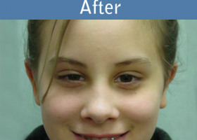 Milwaukee Plastic Surgery - Otoplasty - 1-2
