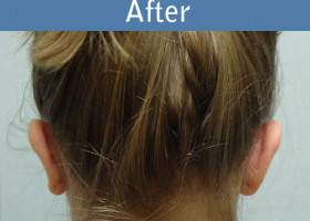 Milwaukee Plastic Surgery - Otoplasty - 1-4