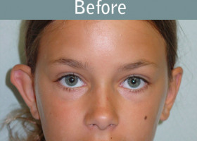 Milwaukee Plastic Surgery - Otoplasty - 2-1