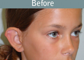 Milwaukee Plastic Surgery - Otoplasty - 2-3