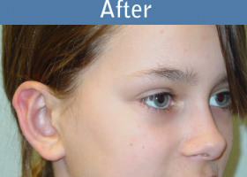Milwaukee Plastic Surgery - Otoplasty - 2-4