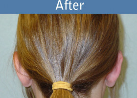 Milwaukee Plastic Surgery - Otoplasty - 2-6