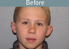 Milwaukee Plastic Surgery - Otoplasty - 3-1