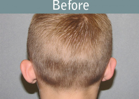Milwaukee Plastic Surgery - Otoplasty - 3-5