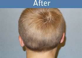 Milwaukee Plastic Surgery - Otoplasty - 3-6