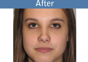 Milwaukee Plastic Surgery - Rhinoplasty - 10-2