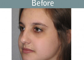 Milwaukee Plastic Surgery - Rhinoplasty - 10-3