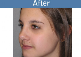 Milwaukee Plastic Surgery - Rhinoplasty - 10-4