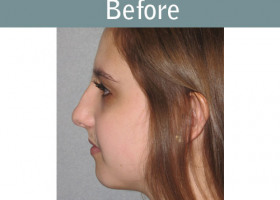 Milwaukee Plastic Surgery - Rhinoplasty - 10-5
