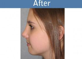 Milwaukee Plastic Surgery - Rhinoplasty - 10-6
