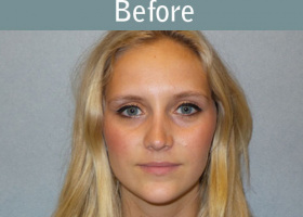 Milwaukee Plastic Surgery - Rhinoplasty - 10-1