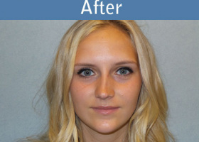 Milwaukee Plastic Surgery - Rhinoplasty - 10-2