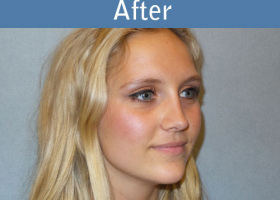 Milwaukee Plastic Surgery - Rhinoplasty - 10-4