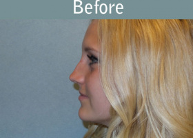 Milwaukee Plastic Surgery - Rhinoplasty - 10-5