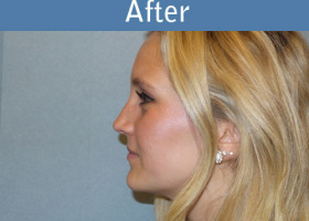 Milwaukee Plastic Surgery - Rhinoplasty - 10-6