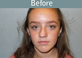 Milwaukee Plastic Surgery - Rhinoplasty - 11-1