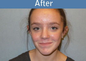 Milwaukee Plastic Surgery - Rhinoplasty - 11-2