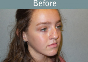 Milwaukee Plastic Surgery - Rhinoplasty - 11-3