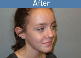 Milwaukee Plastic Surgery - Rhinoplasty - 11-4