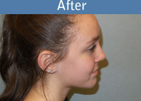 Milwaukee Plastic Surgery - Rhinoplasty - 11-6