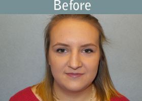 Milwaukee Plastic Surgery - Rhinoplasty - 12-1