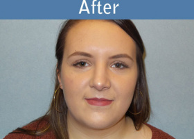 Milwaukee Plastic Surgery - Rhinoplasty - 12-2