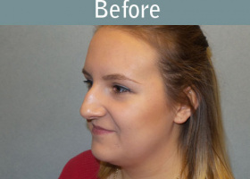 Milwaukee Plastic Surgery - Rhinoplasty - 12-3