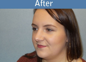 Milwaukee Plastic Surgery - Rhinoplasty - 12-4
